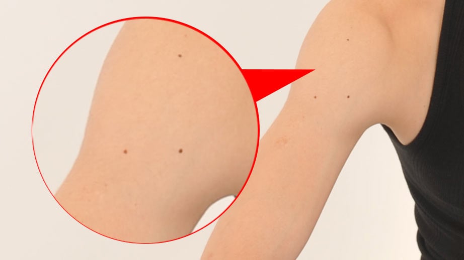 ほくろのある肌の写真